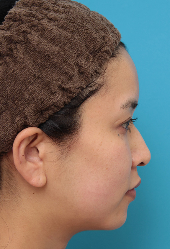 症例写真,30代女性にウルセラシステムを行い、たるんだ頬と顎下を引き締め、リフトアップした症例写真,After（3ヶ月後）,ba_ulthera022_b02.jpg