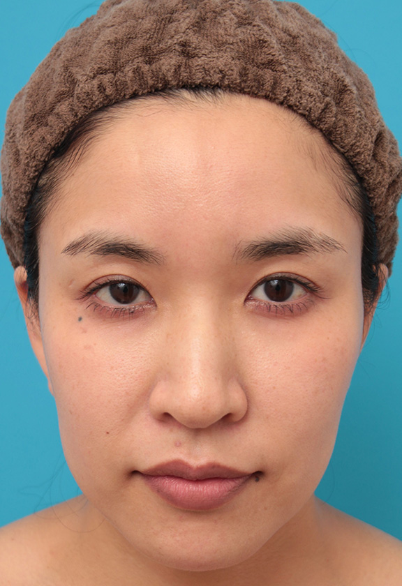 ウルセラシステム,30代女性にウルセラシステムを行い、たるんだ頬と顎下を引き締め、リフトアップした症例写真,Before,ba_ulthera022_b01.jpg