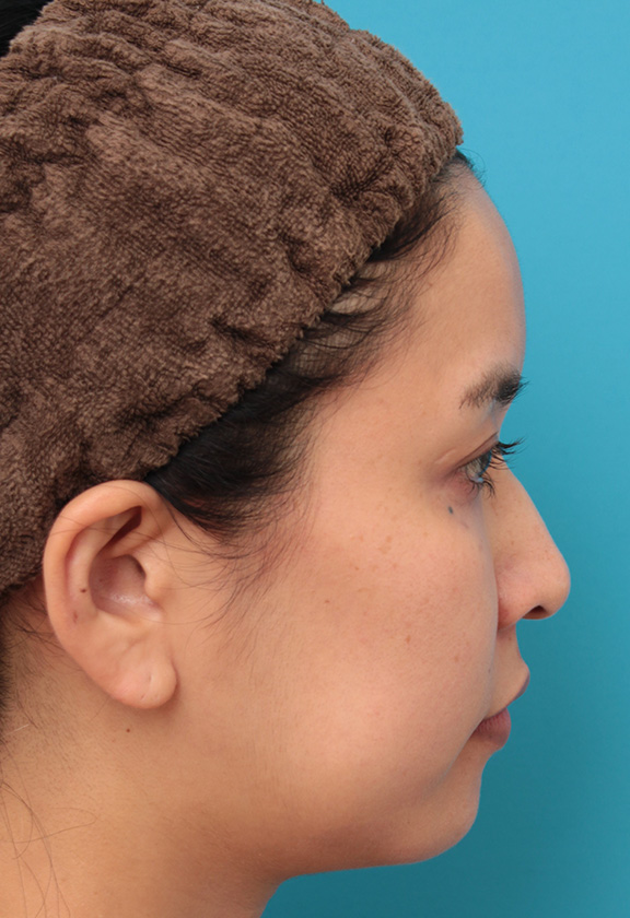 ウルセラシステム,30代女性にウルセラシステムを行い、たるんだ頬と顎下を引き締め、リフトアップした症例写真,Before,ba_ulthera022_b02.jpg