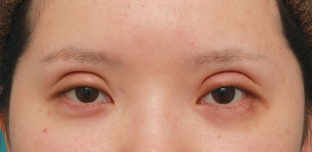 症例写真,患者様の希望で二重まぶたミニ切開法で幅の広い平行型二重を作った症例写真,6日後,目を開けた状態,mainpic_mini_sekkai041d.jpg