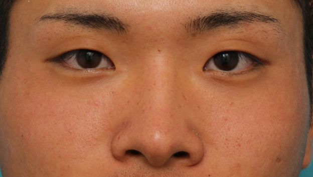症例写真,長期持続型ヒアルロン酸により鼻を高くした症例写真,手術前,mainpic_ryubi2031a.jpg