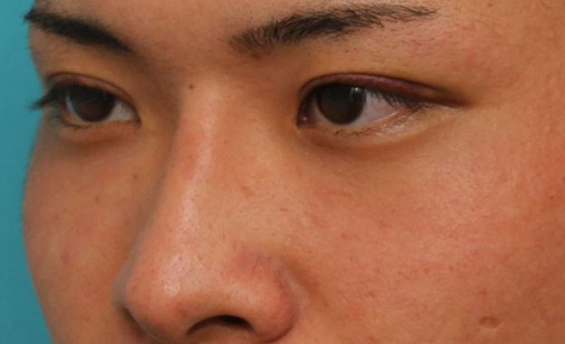 症例写真,長期持続型ヒアルロン酸により鼻を高くした症例写真,1週間後,mainpic_ryubi2031g.jpg