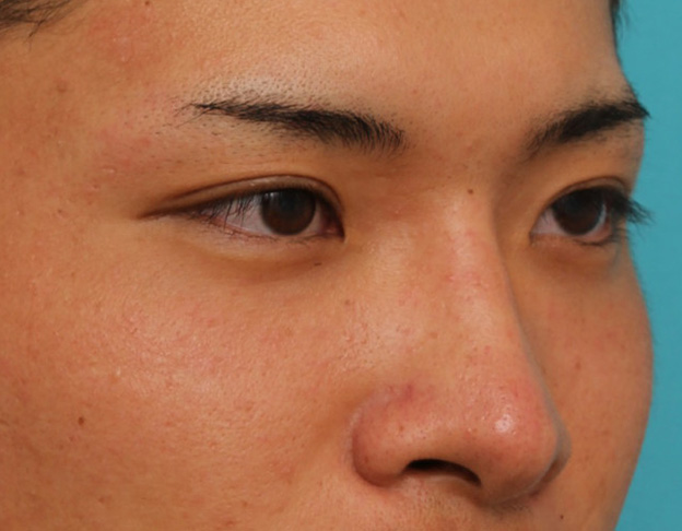 症例写真,長期持続型ヒアルロン酸により鼻を高くした症例写真,1ヶ月後,mainpic_ryubi2031l.jpg