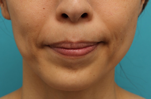 症例写真,注射式シワ取り ボツリヌストキシン注射で顎の梅ジワを目立たなくした症例写真,After（1ヶ月後）,ba_botox_puchi029_b01.jpg