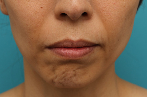 症例写真,注射式シワ取り ボツリヌストキシン注射で顎の梅ジワを目立たなくした症例写真,Before,ba_botox_puchi029_b01.jpg