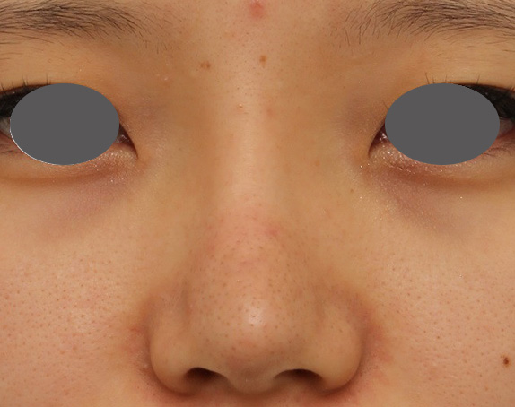 症例写真,鼻シリコンプロテーゼ+鼻先の耳介軟骨移植を行い自然な形で鼻筋を通した症例写真,After（6ヶ月後）,ba_ryubi1048_b01.jpg
