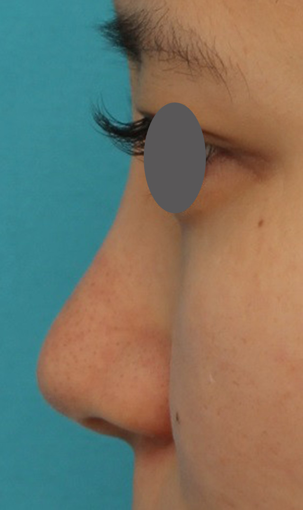 症例写真,鼻シリコンプロテーゼ+鼻先の耳介軟骨移植を行い自然な形で鼻筋を通した症例写真,3ヶ月後,mainpic_ryubi1048n.jpg