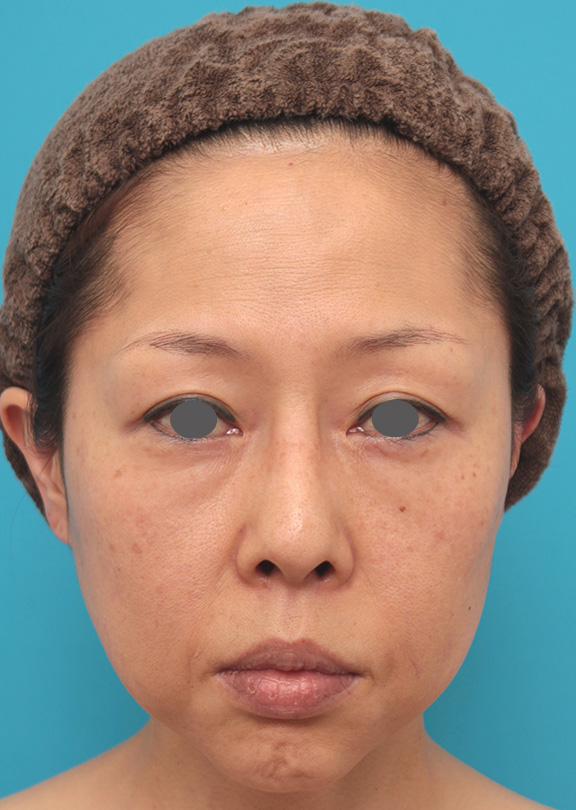 イタリアンリフトファイン,イタリアンリフトファインで顔全体の肌の張りが出て引き締まった40代女性の症例写真,Before,ba_italianlift_fine018_b01.jpg