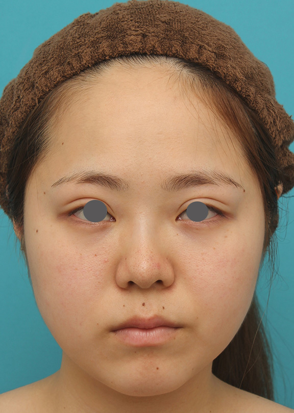 症例写真,小顔専用脂肪溶解注射メソシェイプフェイスで一回り顔が小さくなった症例写真,After（4回目注射後2週間）,ba_meso_face007_b01.jpg