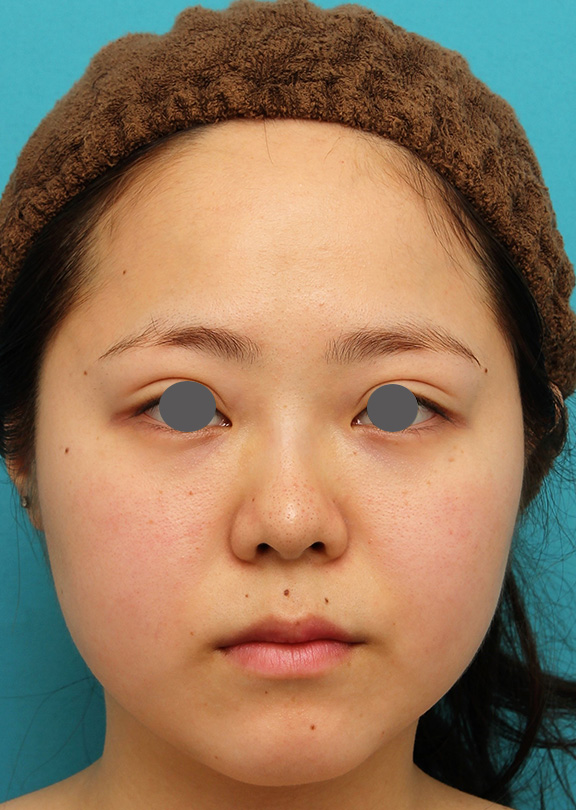 症例写真,小顔専用脂肪溶解注射メソシェイプフェイスで一回り顔が小さくなった症例写真,Before,ba_meso_face007_b01.jpg
