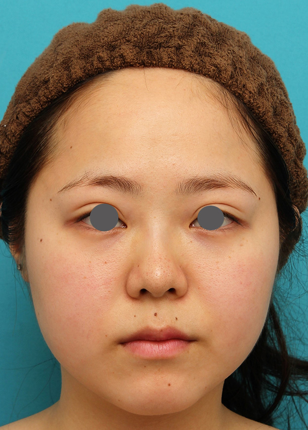 症例写真,小顔専用脂肪溶解注射メソシェイプフェイスで一回り顔が小さくなった症例写真,治療前,mainpic_meso_face007a.jpg