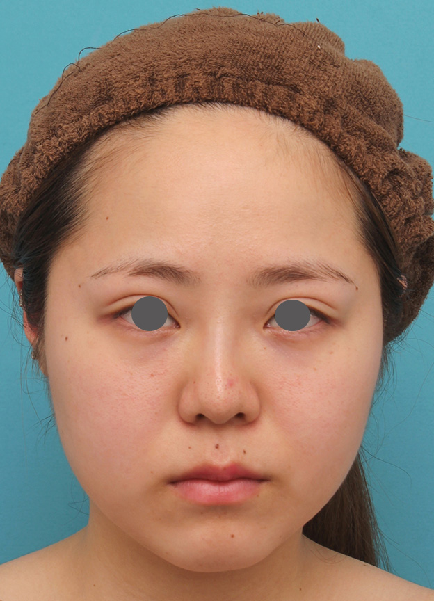 症例写真,小顔専用脂肪溶解注射メソシェイプフェイスで一回り顔が小さくなった症例写真,1回目注射後3ヶ月,mainpic_meso_face007c.jpg