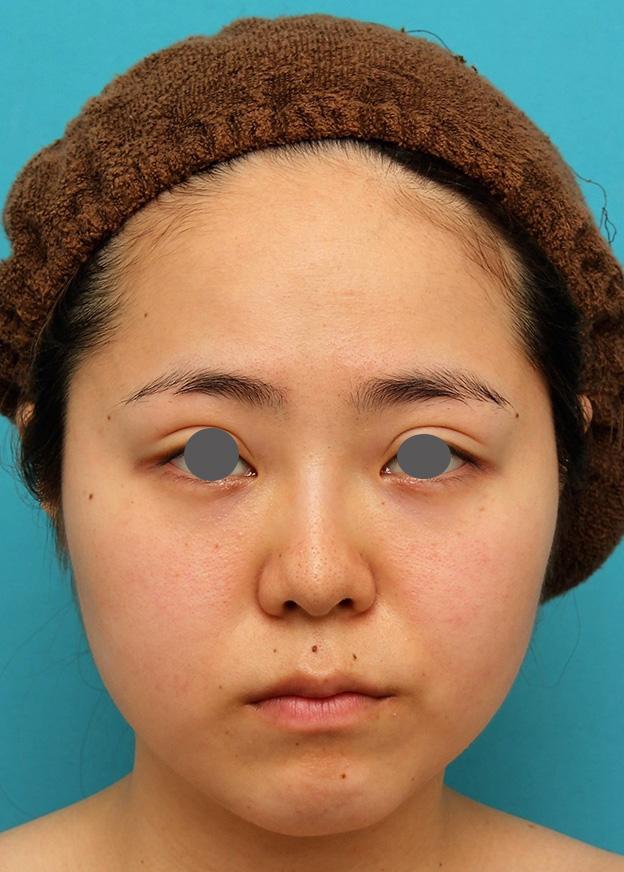 症例写真,小顔専用脂肪溶解注射メソシェイプフェイスで一回り顔が小さくなった症例写真,2回目注射後1ヶ月,mainpic_meso_face007d.jpg
