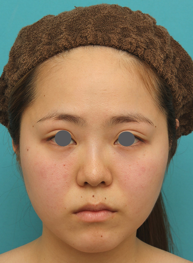 症例写真,小顔専用脂肪溶解注射メソシェイプフェイスで一回り顔が小さくなった症例写真,3回目注射後1ヶ月,mainpic_meso_face007e.jpg