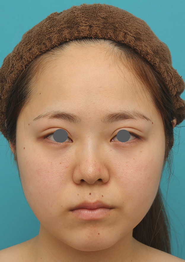 症例写真,小顔専用脂肪溶解注射メソシェイプフェイスで一回り顔が小さくなった症例写真,4回目注射後2週間,mainpic_meso_face007f.jpg