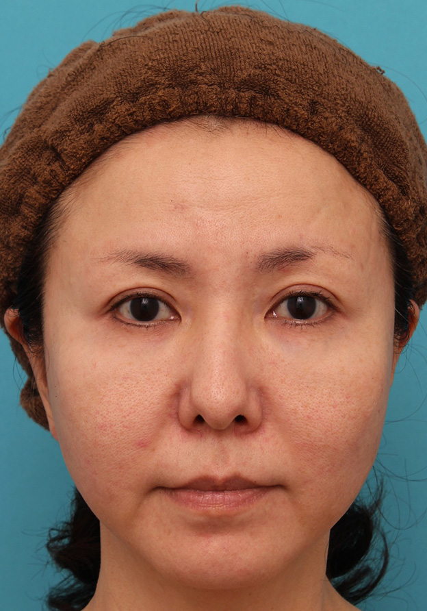 症例写真,上まぶたたるみ取り手術とタレ目形成（グラマラスライン）を同時に行った40代女性の症例写真,6ヶ月後,目を開けた状態,mainpic_tarumi013j.jpg