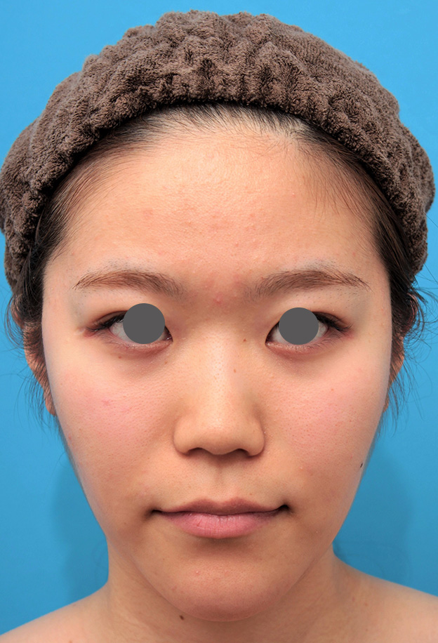 症例写真,鼻のシリコンプロテーゼと鼻先の耳介軟骨移植を同時に行った症例写真,手術前,mainpic_ryubi1049a.jpg