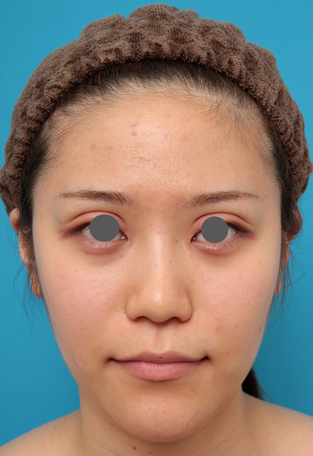 症例写真,鼻のシリコンプロテーゼと鼻先の耳介軟骨移植を同時に行った症例写真,3週間後,mainpic_ryubi1049d.jpg
