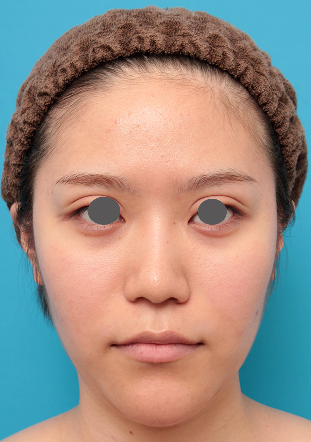 症例写真,鼻のシリコンプロテーゼと鼻先の耳介軟骨移植を同時に行った症例写真,6ヶ月後,mainpic_ryubi1049e.jpg