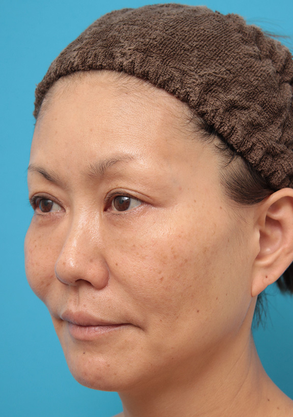 症例写真,額~こめかみに長期持続型ヒアルロン酸を注射しおでこを丸くした症例写真,After(3ヶ月後),ba_hitai_hyaluron002_b02.jpg