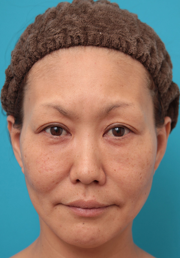 症例写真,額~こめかみに長期持続型ヒアルロン酸を注射しおでこを丸くした症例写真,治療前,mainpic_hitai_hyaluron002a.jpg