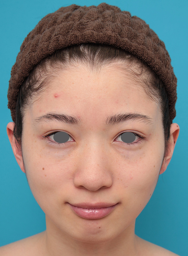 症例写真,人工骨セメントで額形成手術を行い、平らなおでこをぽっこり丸くした症例写真,手術前,mainpic_hitaicement002a.jpg