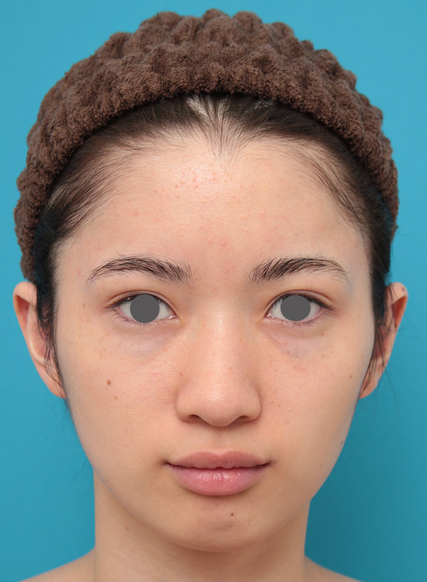 症例写真,人工骨セメントで額形成手術を行い、平らなおでこをぽっこり丸くした症例写真,2ヶ月後,mainpic_hitaicement002d.jpg