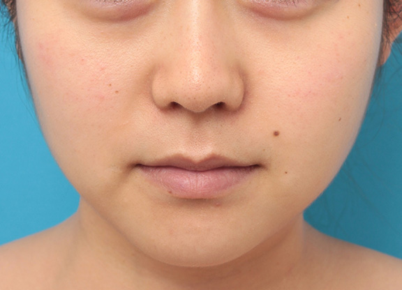 バッカルファット除去をして小顔になった20代女性の症例写真,After（6ヶ月後）,ba_buccalfat016_a01.jpg