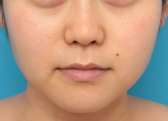 症例写真,バッカルファット除去をして小顔になった20代女性の症例写真,Before,ba_buccalfat016_b01.jpg