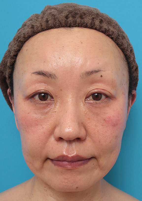 症例写真,50代女性に小顔専用脂肪溶解注射メソシェイプフェイスを行った症例写真,After（5回注射後1ヶ月）,ba_meso_face008_b01.jpg