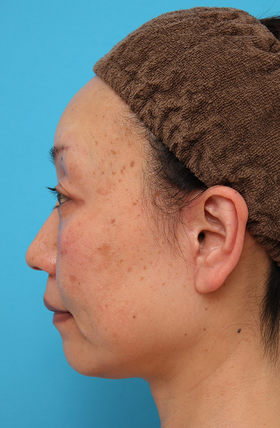 症例写真,50代女性に小顔専用脂肪溶解注射メソシェイプフェイスを行った症例写真,After（5回注射後1ヶ月）,ba_meso_face008_b02.jpg