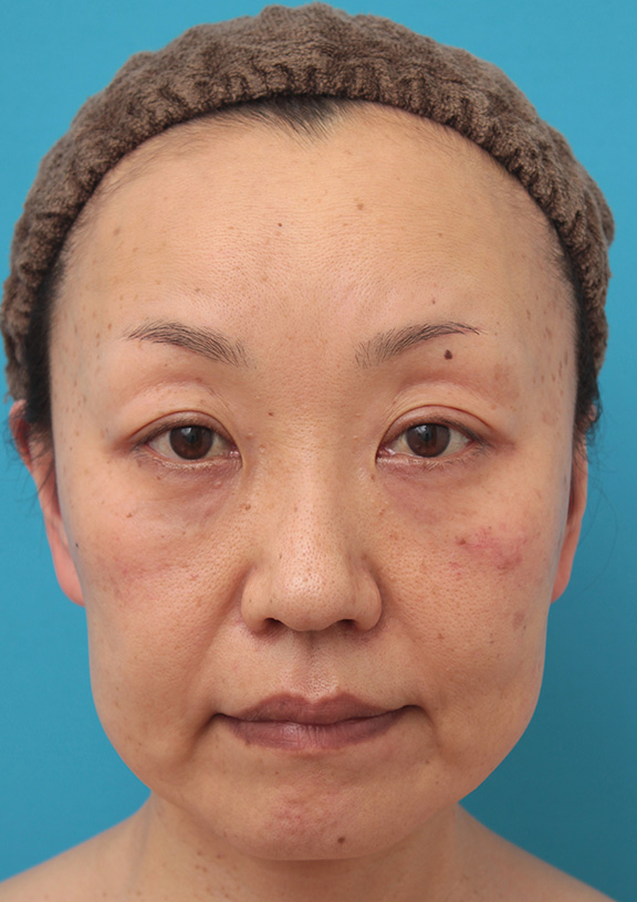 症例写真,50代女性に小顔専用脂肪溶解注射メソシェイプフェイスを行った症例写真,Before,ba_meso_face008_b01.jpg
