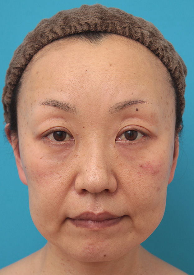 症例写真,50代女性に小顔専用脂肪溶解注射メソシェイプフェイスを行った症例写真,治療前,mainpic_meso_face008a.jpg