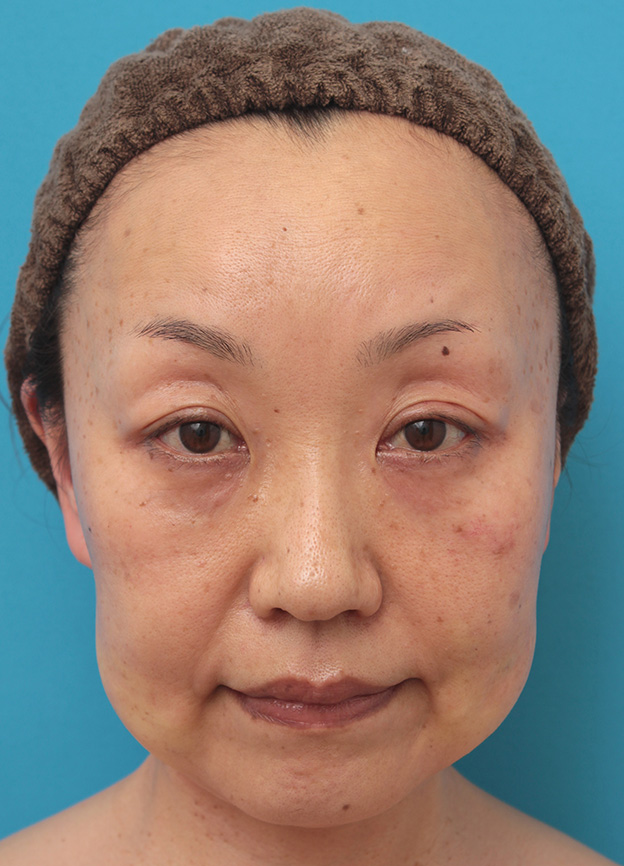 症例写真,50代女性に小顔専用脂肪溶解注射メソシェイプフェイスを行った症例写真,1回目注射直後,mainpic_meso_face008b.jpg