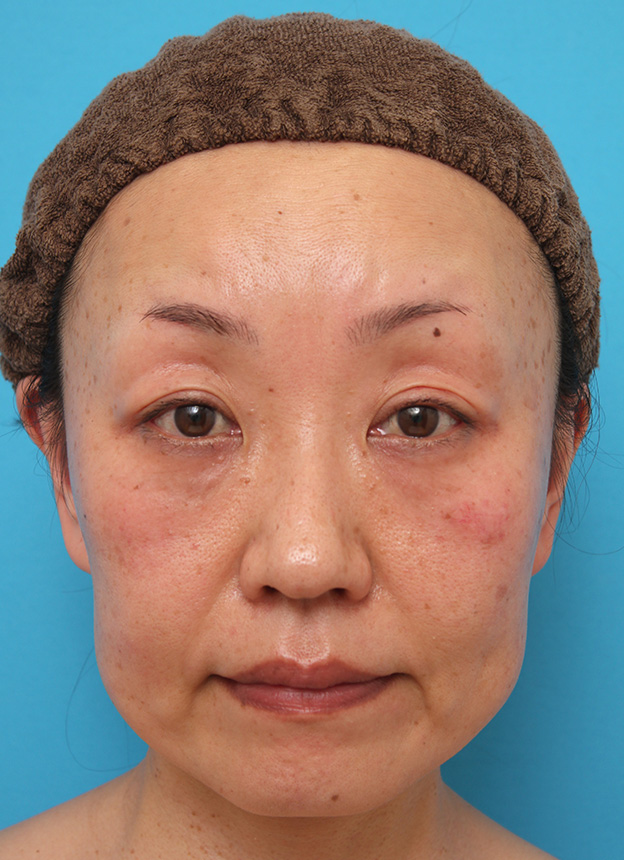 症例写真,50代女性に小顔専用脂肪溶解注射メソシェイプフェイスを行った症例写真,1回目注射後1ヶ月,mainpic_meso_face008c.jpg