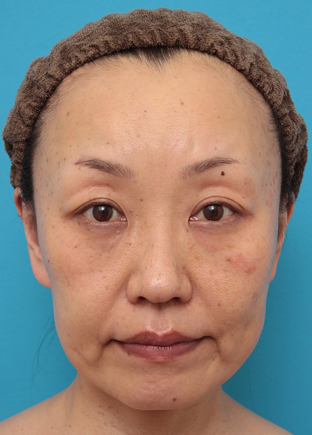 症例写真,50代女性に小顔専用脂肪溶解注射メソシェイプフェイスを行った症例写真,3回目注射後1ヶ月,mainpic_meso_face008d.jpg