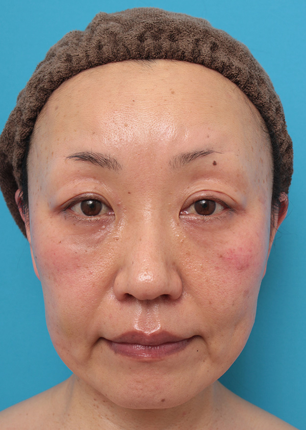 症例写真,50代女性に小顔専用脂肪溶解注射メソシェイプフェイスを行った症例写真,5回目注射後1ヶ月,mainpic_meso_face008e.jpg