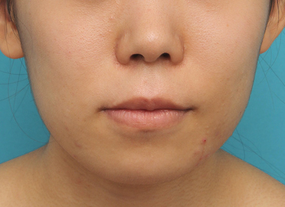 症例写真,上下の厚い唇を口唇縮小手術で薄くした症例写真,After（6ヶ月後）,ba_usuku009_b01.jpg