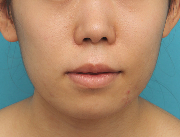 症例写真,上下の厚い唇を口唇縮小手術で薄くした症例写真,After（6ヶ月後）,ba_usuku009_b02.jpg