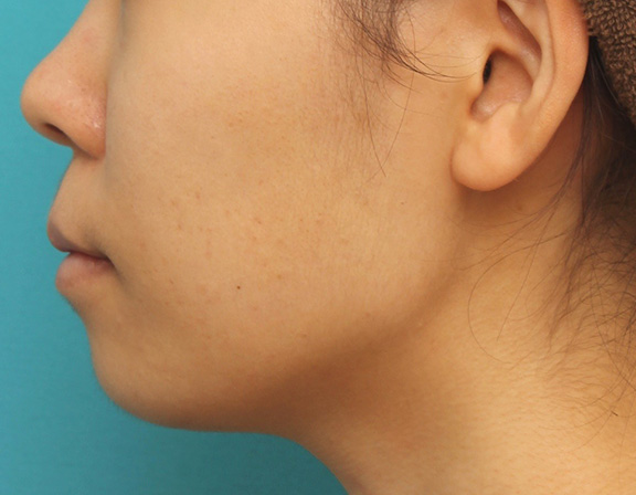症例写真,上下の厚い唇を口唇縮小手術で薄くした症例写真,After（6ヶ月後）,ba_usuku009_b05.jpg