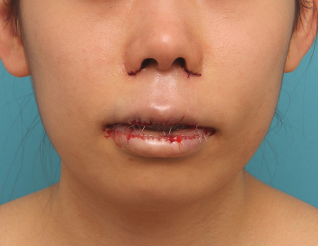 症例写真,上下の厚い唇を口唇縮小手術で薄くした症例写真,手術直後,mainpic_usuku009c.jpg