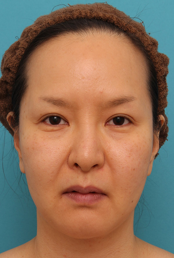 顔の脂肪吸引をし、小顔になってたるみも改善した40代女性の症例写真,After（6ヶ月後）,ba_shibo004_a01.jpg