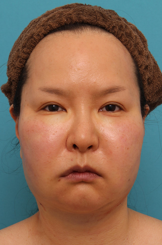 症例写真,顔の脂肪吸引をし、小顔になってたるみも改善した40代女性の症例写真,手術直後,mainpic_shibo004b.jpg