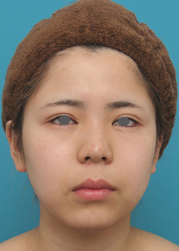 脂肪吸引（頬、あご）,頬、顎下の脂肪吸引をし、下膨れの顔の輪郭が改善した症例写真,After（6ヶ月後）,ba_shibo005_a01.jpg