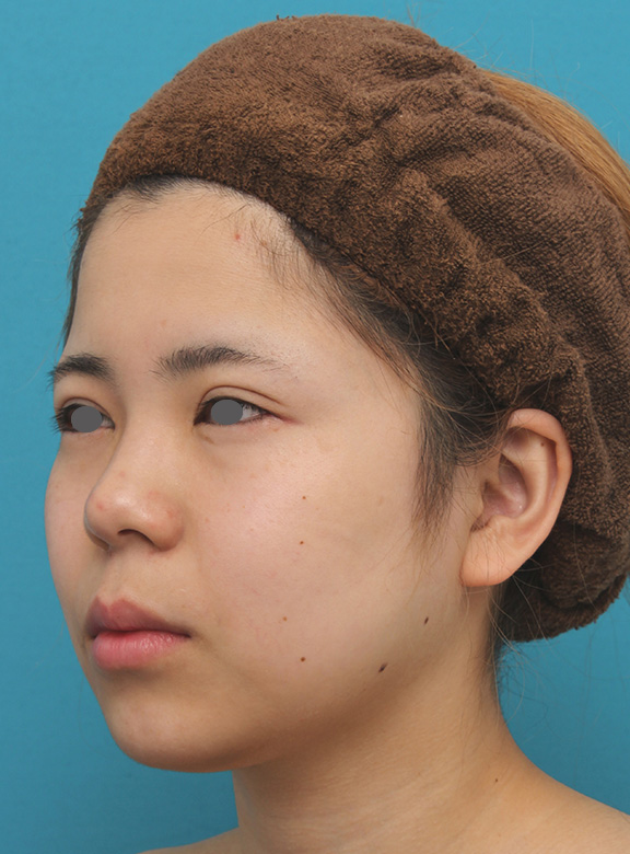 症例写真,頬、顎下の脂肪吸引をし、下膨れの顔の輪郭が改善した症例写真,After（6ヶ月後）,ba_shibo005_b02.jpg