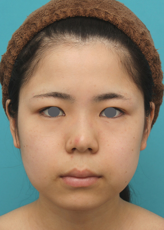 頬、顎下の脂肪吸引をし、下膨れの顔の輪郭が改善した症例写真,Before,ba_shibo005_b01.jpg
