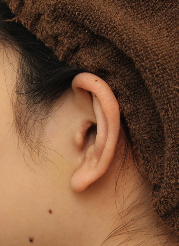 耳介軟骨移植（鼻先を出す）,鼻先と鼻柱に耳介軟骨移植を行い、バランスを良くした症例写真,After（6ヶ月後）,ba_jikai044_b05.jpg