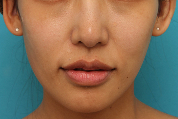 症例写真,上唇にヒアルロン酸を注射して厚みを出し、上下のバランスを整えた症例写真,After（1週間後）,ba_atsuku015_b02.jpg