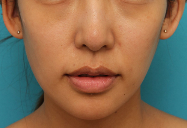 症例写真,上唇にヒアルロン酸を注射して厚みを出し、上下のバランスを整えた症例写真,治療前,mainpic_atsuku015b.jpg