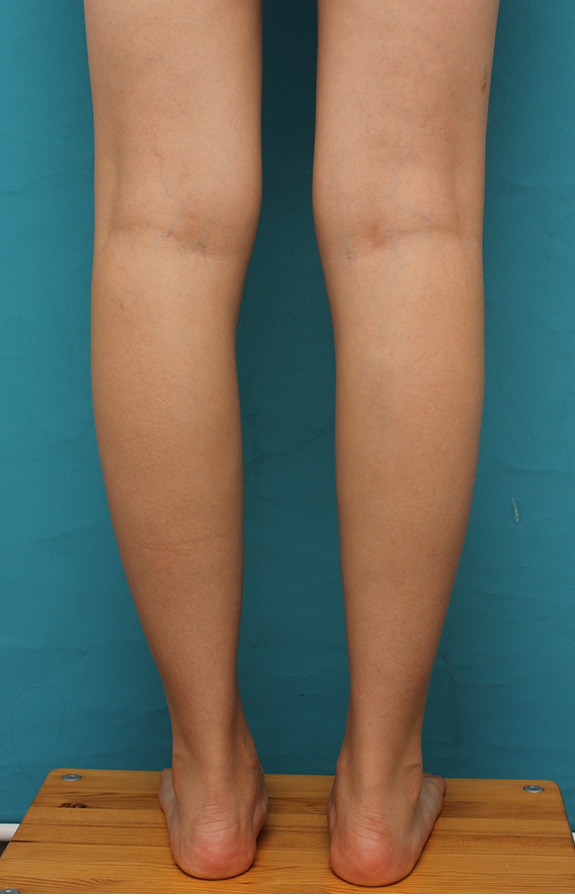 ふくらはぎボツリヌストキシン注射で、細い脚を更に細くした症例写真,After（注射後3ヶ月後）,ba_leg011_a01.jpg